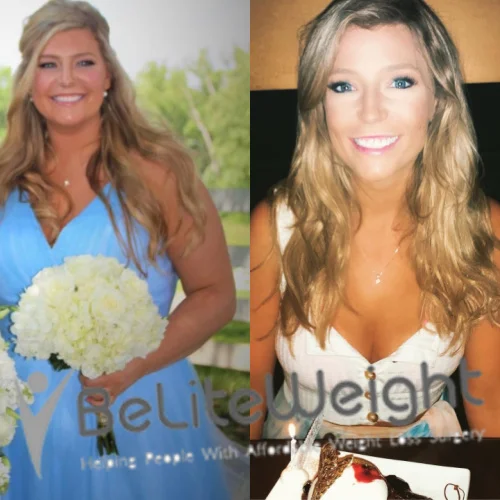 Weight Loss Surgery Before And After